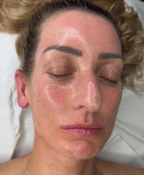 Placenta Facial