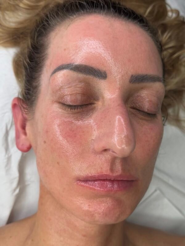 Placenta Facial