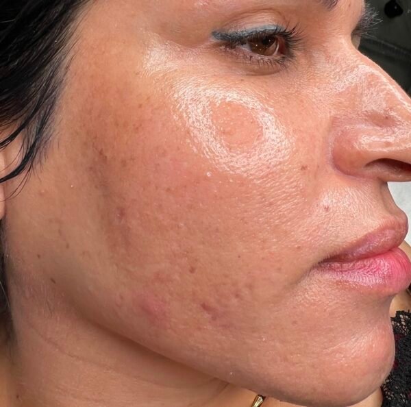 Microdermabrasion