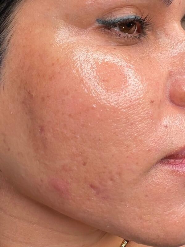Microdermabrasion